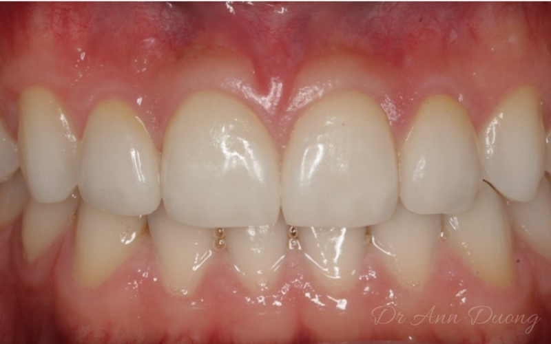Four incisors repaired with three porcelain veneers and a ceramic crown