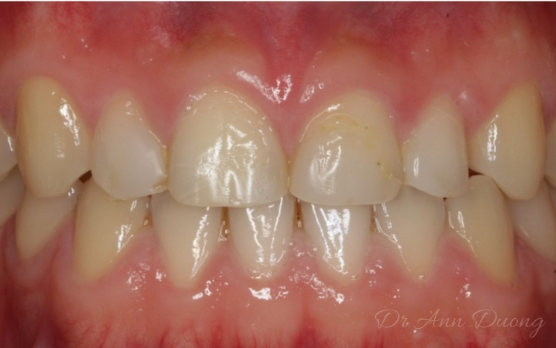 Before ceramic veneers, these four incisors had been termporarily restored with composite resin