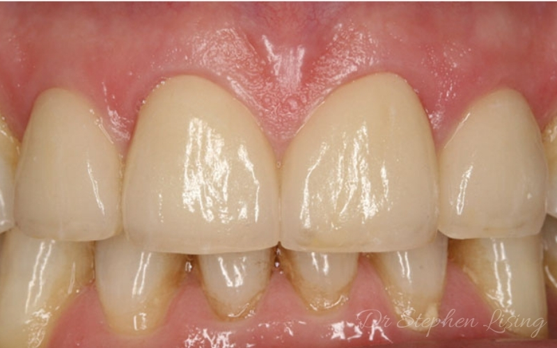 Smile enhancement after invisalign, whitening, and placement of porcelain crowns