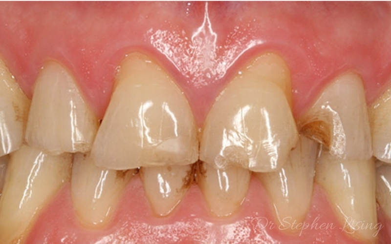 Before smile enhancement, showing chipped and decayed front teeth