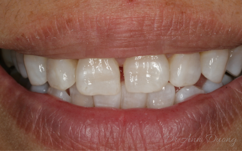 The same case after whitening