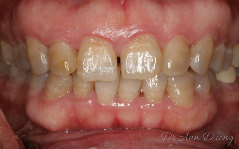 Tetracycline stained teeth before whitening